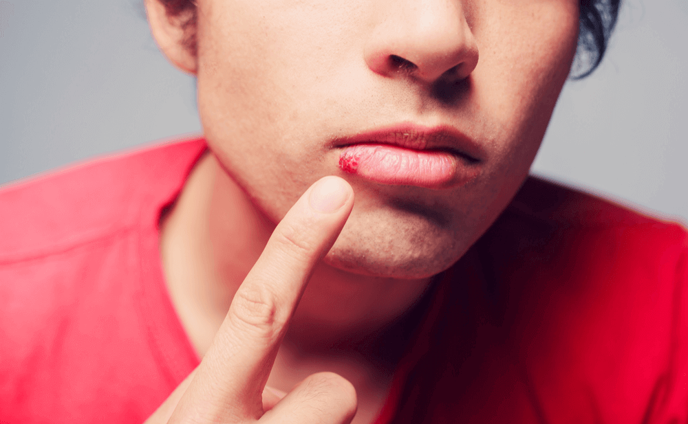Síntomas y tratamiento para curar el herpes